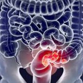 Профилактика колоректального рака. Профилактика колоректального рака.