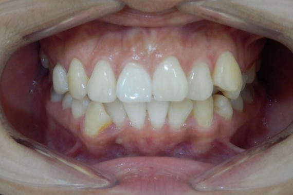 Зубы ДО лечения брекетами Clarity Advanced
