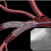 Стентирование и ангиопластика: минимально инвазивные методы лечения коронарных заболеваний
