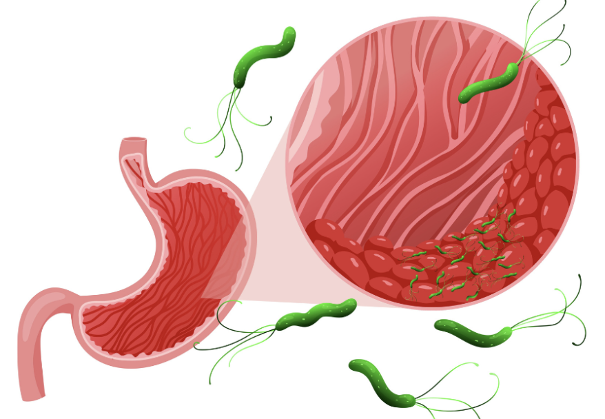 Лечение Helicobacter pylori бесплатно — клиническое исследование в Клинике ЭКСПЕРТ Лечение Helicobacter pylori бесплатно — клиническое исследование в Клинике ЭКСПЕРТ