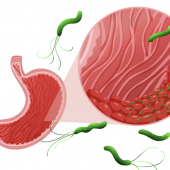 Лечение Helicobacter pylori бесплатно — клиническое исследование в Клинике ЭКСПЕРТ Лечение Helicobacter pylori бесплатно — клиническое исследование в Клинике ЭКСПЕРТ