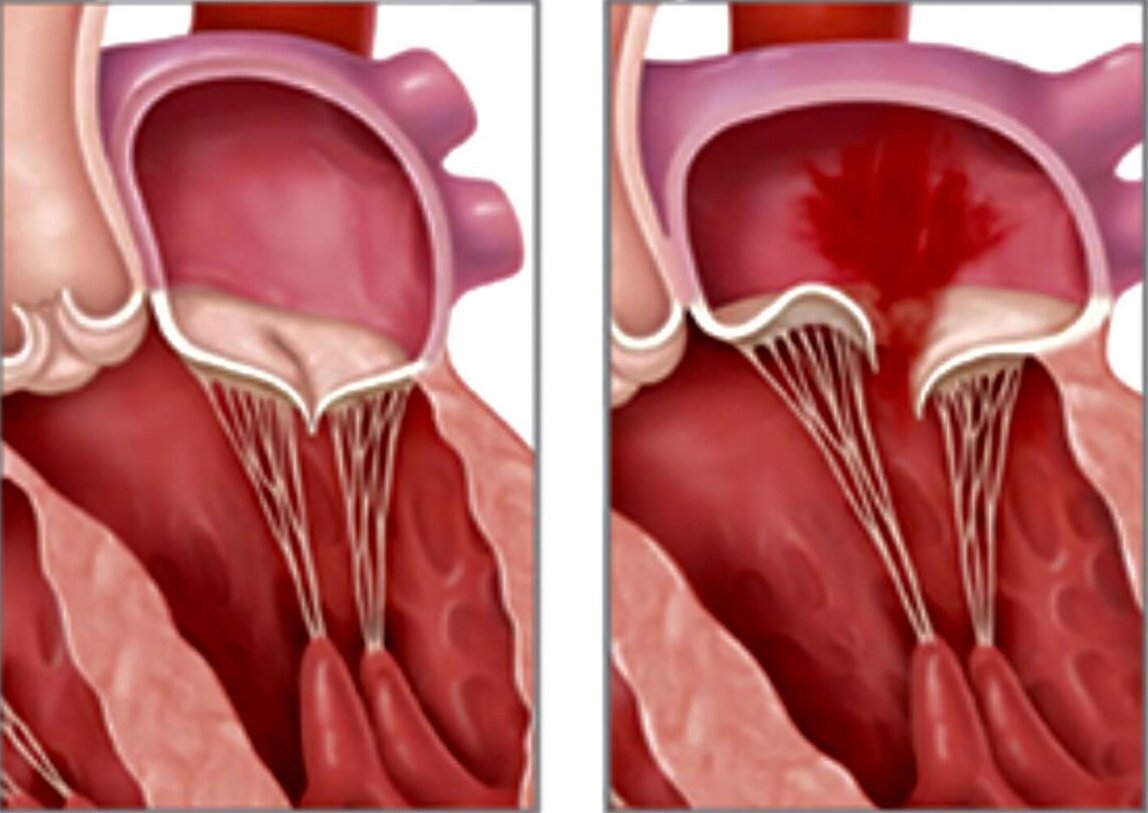 Пролапс митрального клапана: когда это вариант нормы Пролапс митрального клапана: когда это вариант нормы