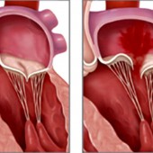 Пролапс митрального клапана: когда это вариант нормы Пролапс митрального клапана: когда это вариант нормы