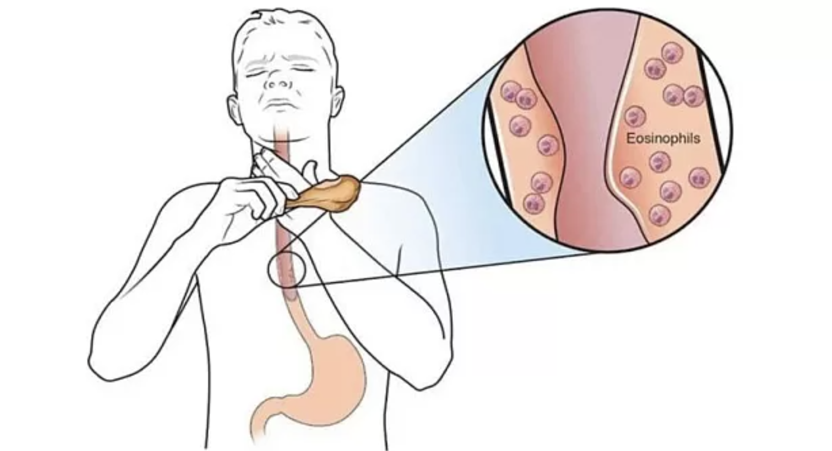 Эозинофильный эзофагит