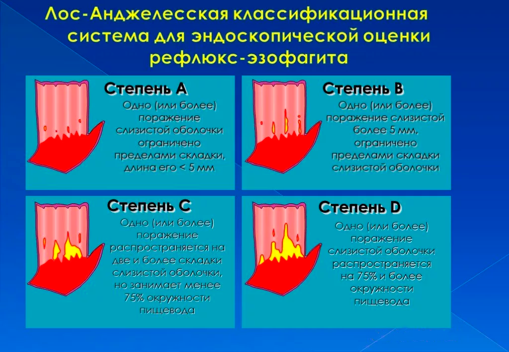Эндоскопические критерии ГЭРБ Эндоскопические критерии ГЭРБ