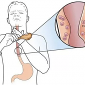 Эозинофильный эзофагит