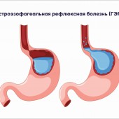 Гастроэзофагеальная рефлюксная болезнь ГЭРБ