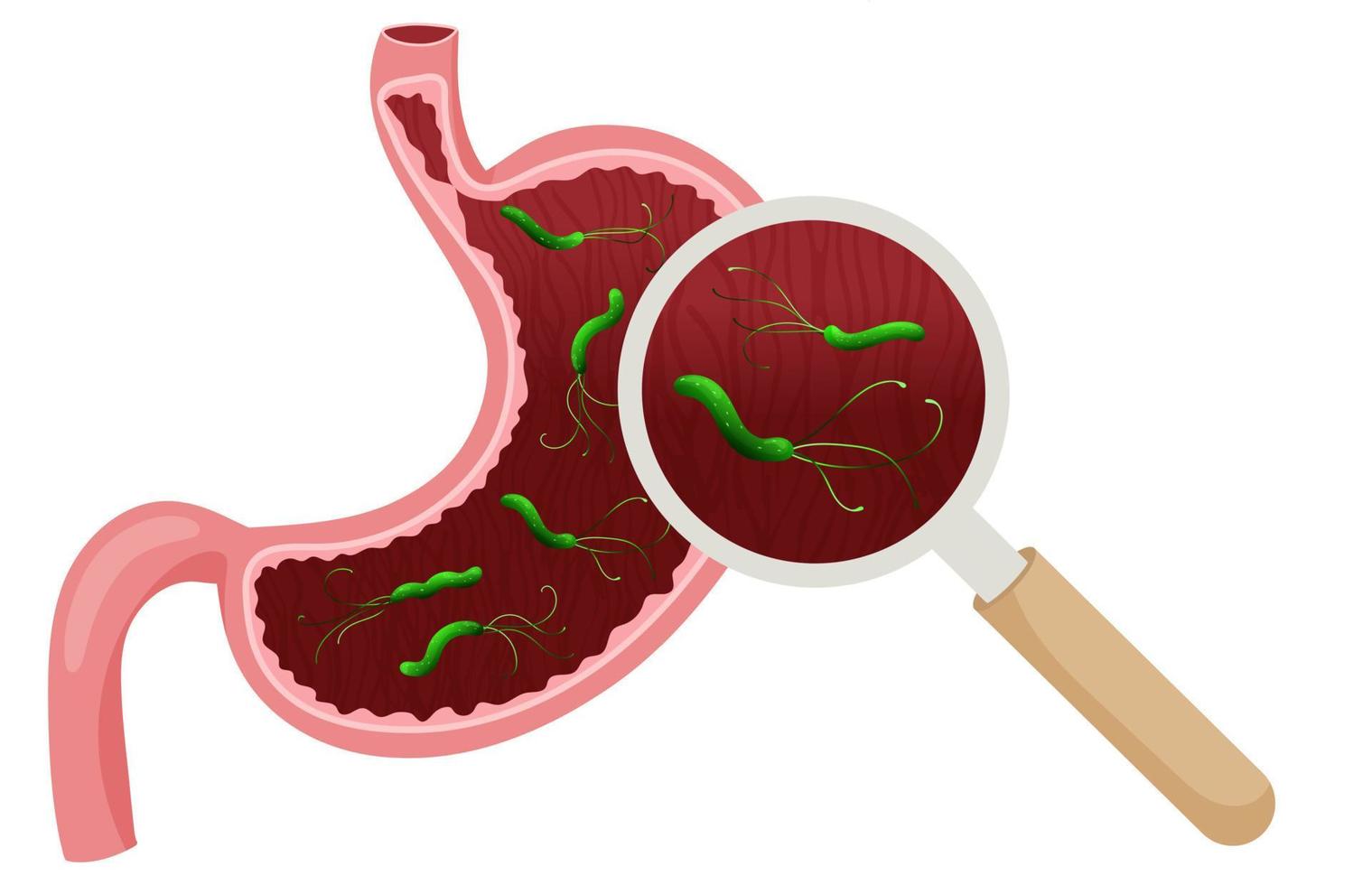 Как НЕ заразится Н.pylori