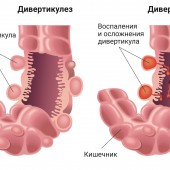 Дивертикулы