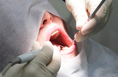  Профгигиена полости рта - этап ультразвуковой чистки