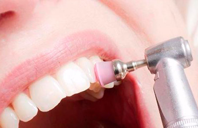  Профгигиена полости рта - этап полировки зубов