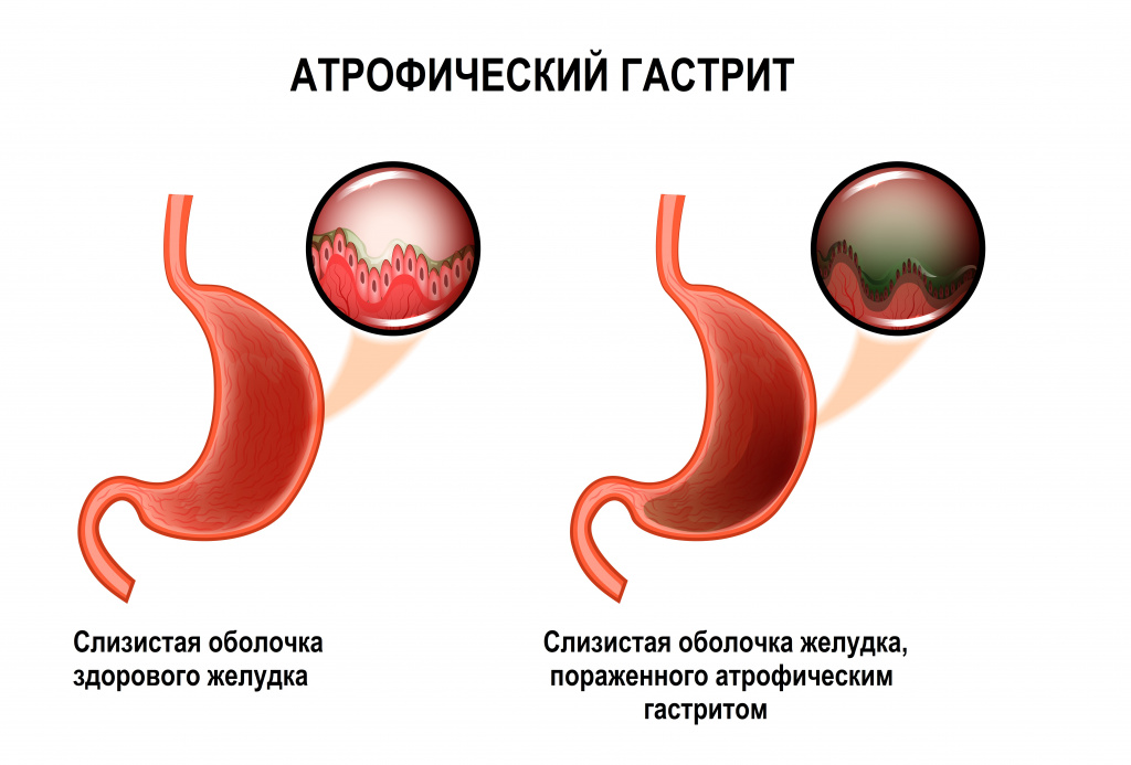 Лечение гастрита в Москве, прием врача в клинике МедЭлит