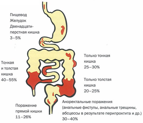 Болезнь Крона