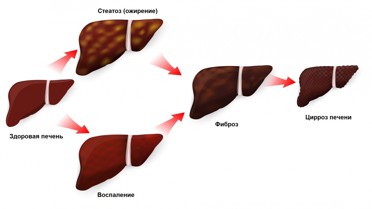 Стадии развития цирроза печени