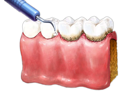 Эффект от ультразвуковой чистки зубов