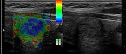 Пример УЗИ с эластографией щитовидной железы - опухоль