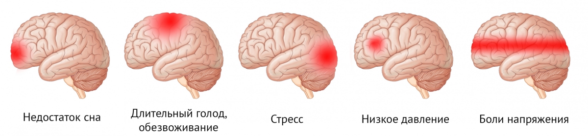 Локализация головных болей