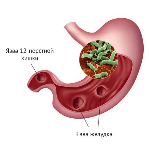 Влияние Хеликобактера ни желудок и 12-перстную кишку