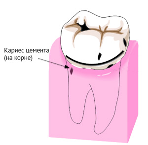 Лечение кариеса на корне зуба (кариес цемента)