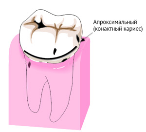 Лечение кариеса на стенке между зубами (апроксимальный или контактный кариес)